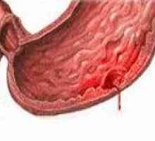 Želodčna razjeda krvavitev
