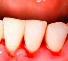 Krvavitev dlesni