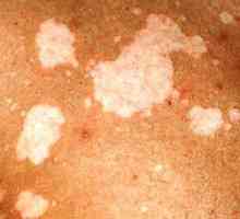 Chromophytosis: slika, zdravljenje