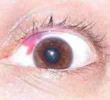 Mehanske poškodbe oči