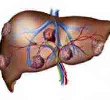 Metastatski karcinom jeter