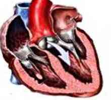 Mitralne in aorte napak