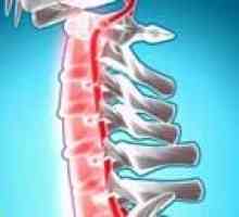 Kršitve spinalne obtoku