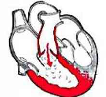 Pljučna insuficienca ventil