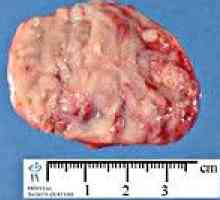 Sympathicoblastoma