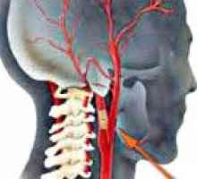 Okluziji karotidnih arterijah