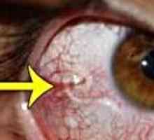 Oslepitev vlaknen bolezen