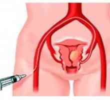Kirurška odstranitev maternice fibroids