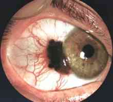 Tumorji očesa
