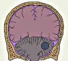 Tumorji malih možganih