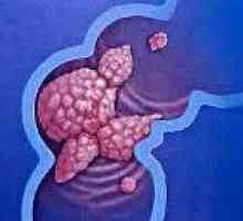 Tumorji debelega črevesa