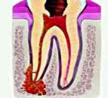 Akutna periodontitis