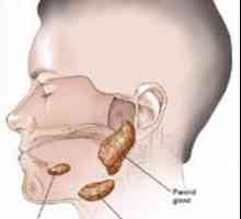 Parotitis (mumpsa)