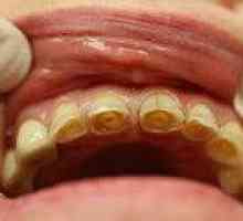 Patološko zobni abraziji