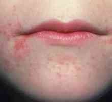 Ustni dermatitis