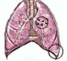 Ploščatocelični karcinom pljuč