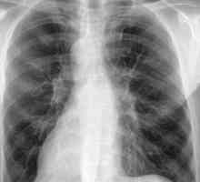 Pljučnica simptomi, znaki, zdravljenje pljučnega pljučnice