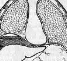 Subdiaphragmatic absces