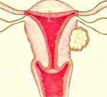 Podseroznaya fibroidi