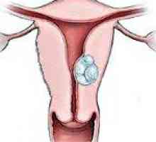 Submukozno fibroidi