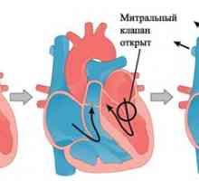 Prolaps mitralne srčne zaklopke
