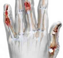 Psoriatični artritis: Simptomi in zdravljenje