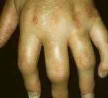 Psoriatični artritis