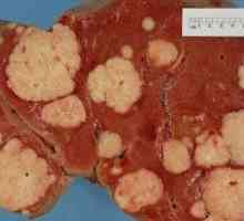 Rak jeter: Simptomi in diagnoza