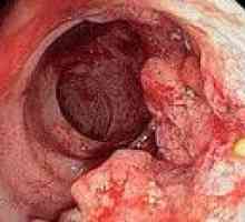 Rak debelega črevesa