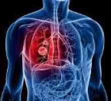 Pljučni rak relapsa