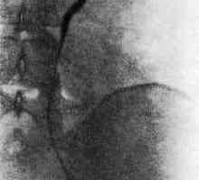 Retroperitonealne fibroze (Ormondova bolezen)