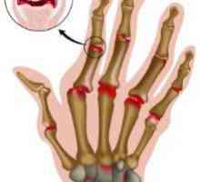 Revmatoidni artritis