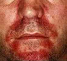 Seboroični dermatitis