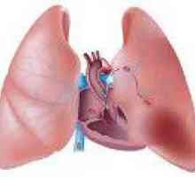Kardio-pljučne insuficience