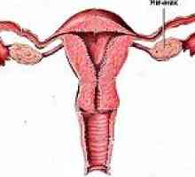 Ovarijski sindrom odporne