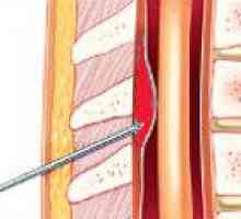 Spinal epiduralna krvavitev