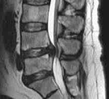 Spinal epiduralna absces