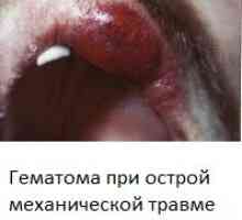 Stomatitis (vnetje ustne votline) s slikami