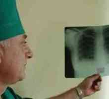 Pulmonalne tuberkuloze
