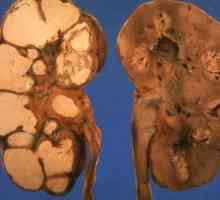 Tuberkuloza urogenitalnega sistema (nephrotuberculosis)