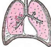 Tuberkulozne plevritis