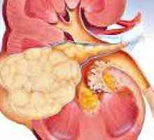 Tubular karcinom ledvičnih celic