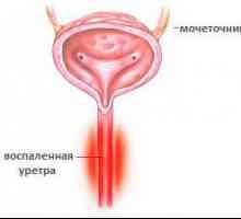 Uretritis pri ženskah