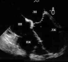 Ultrazvok srca (ehokardiografija)