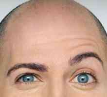 Vrste plešavosti (alopecija)