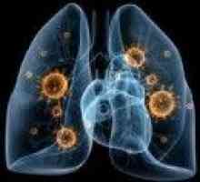 Virus pljučnica