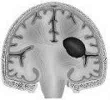 Možganska hematom