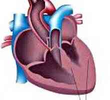 Sekundarni kardiomiopatija