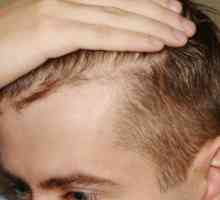 Izpadanje las pri moških: vzroki, zdravljenje, sredstva