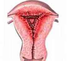 Glandularna hiperplazija endometrija